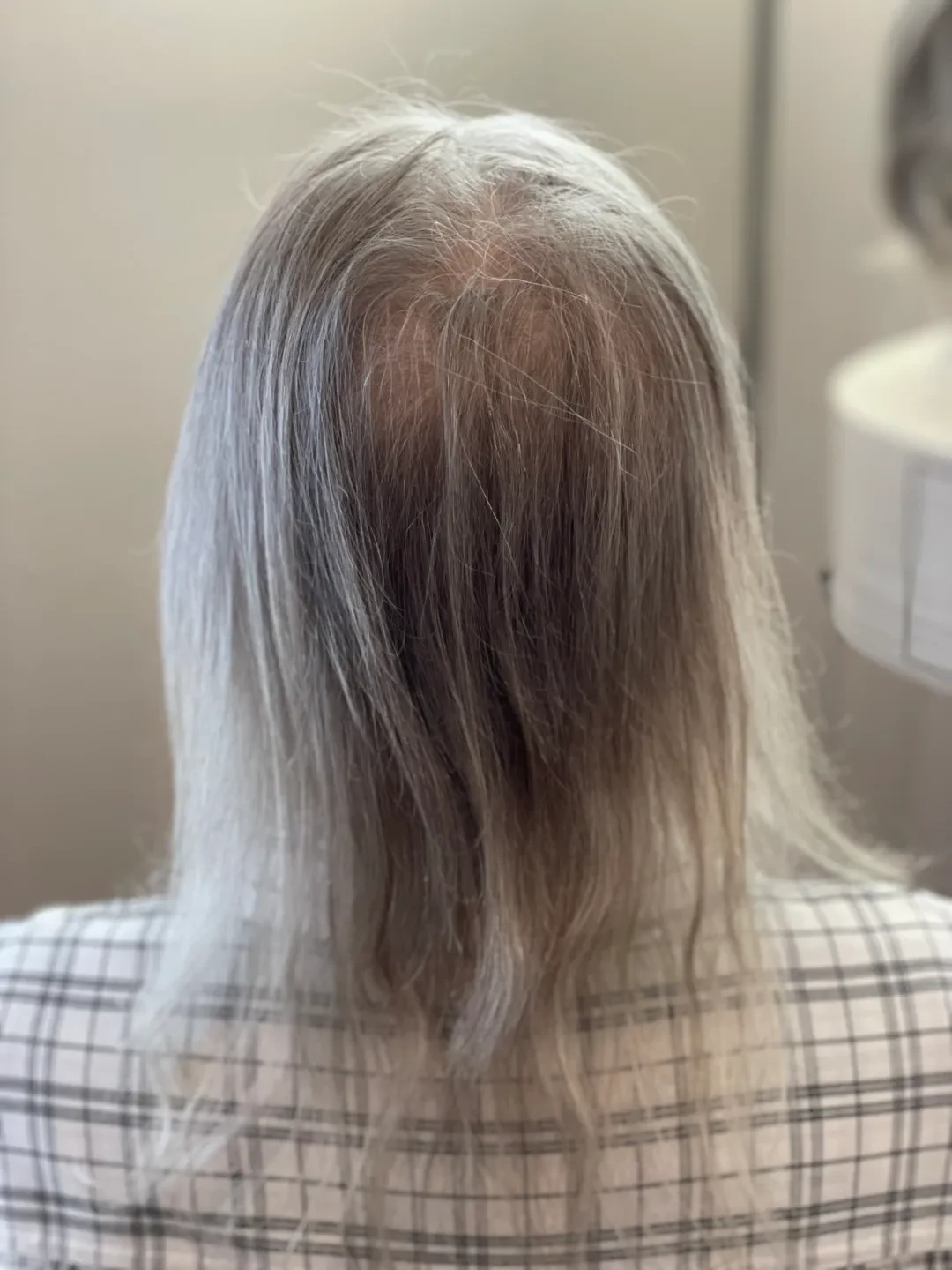 Before — hair before topper consultation